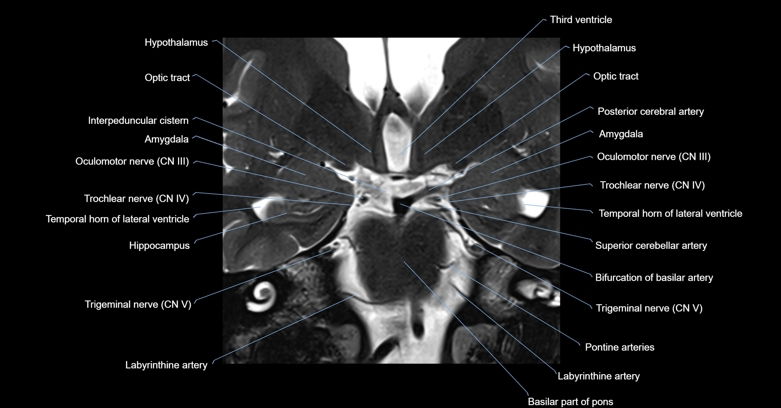 MRI cavernous sinus coronal cross sectional 3T anatomy image-img-00001-00017.webp